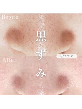 オーキッド(ORCHID)/黒ずみ撃退!毛穴ケア