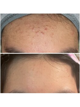 カヌヌ(Kanunu)/プラズマシャワー