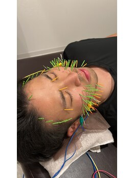 ソラナ(Solana)/男性美容鍼増えてます