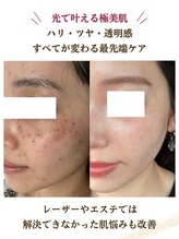 リシェス(Richesse) 全顔 シミケア