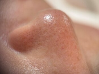 フェリス(FELIZ)の写真/《試せば分かる毛穴ケア革命》年代幅広く悩みの多い毛穴づまりに!3D毛穴洗浄+シルク洗顔で圧倒的な美肌へ☆