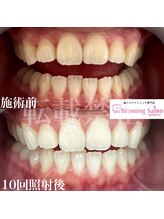 ホワイトニングサロン 福岡博多店 10回コース