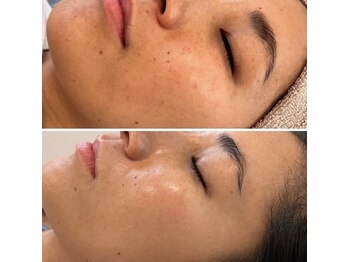 ペリドット(Peridot)/月１肌管理でノーファンデ肌へ