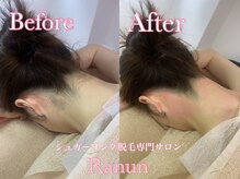 ラナン(Ranun)/うなじシュガーリング脱毛の効果