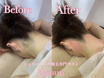 ラナン(Ranun)/うなじシュガーリング脱毛の効果