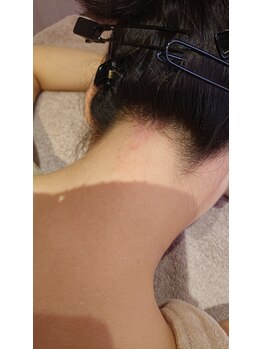 エムスタイル(M-style)/うなじのワックス脱毛