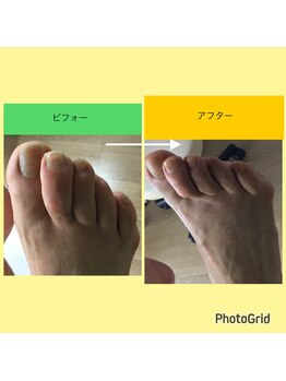 リゼラアンドコー 宇都宮店/巻き爪/肥厚爪、ネイルケア