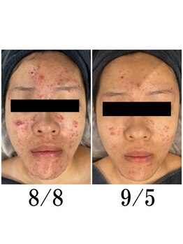 ヘルバ(HERBA)/フェイシャル