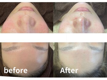 キキ(kiki)/韓国肌管理ララピール