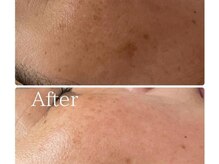 エイプリル/【ハーブピーリング】比較写真