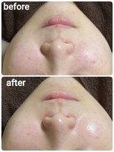 ウララ(ulala)/ララピール1回目