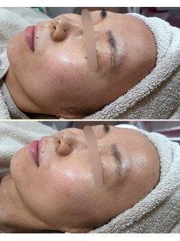 ソワナ(soina)/【神楽坂駅/フェイシャル/毛穴】