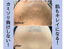 ベルミーランド 浜松天王/脱毛Before→After