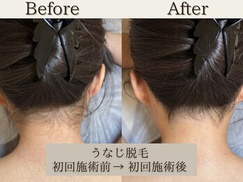 インベスト(INVEST)/うなじ脱毛