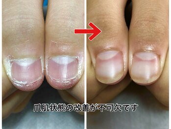 レアムネイル(Leam nail)/爪周りの状態いかがですか？
