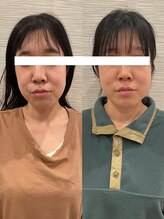 長寿鍼灸院 長寿整骨院/美容鍼100本の効果★（ 3回目）