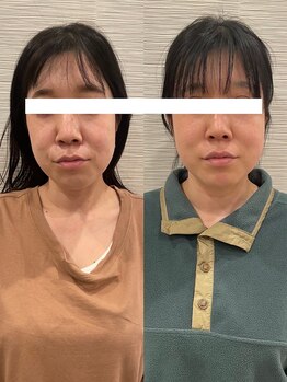 長寿鍼灸院 長寿整骨院/美容鍼100本の効果★（ 3回目）