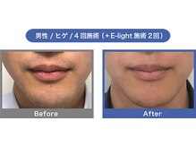 ラヴィ/メンズ髭脱毛★お顔全体◎