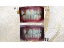 ココホワイトニング(coco whitening)/【シルバーコース８分照射×2】