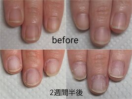 深爪矯正2週間半