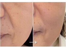 エステドブルー(Este de Bleu)/ビフォーアフター