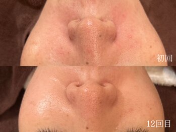 ウォーム(warm)/肌質改善/岡山/フェイシャル