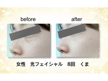 KMB 恵比寿店/光フェイシャル効果
