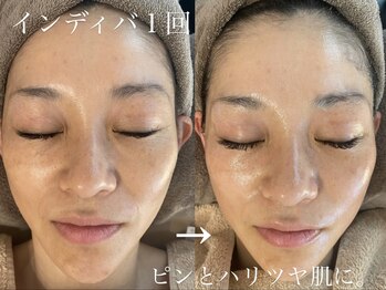 シュリー(Sriii)/インディバ☆ビフォーアフター