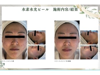 サロンドエクラ 南堀江(salon de eclat)/水素水光ピール