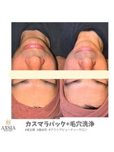 アクシア ビューティー サロン(AXSIA)/カスマラパック＋毛穴洗浄