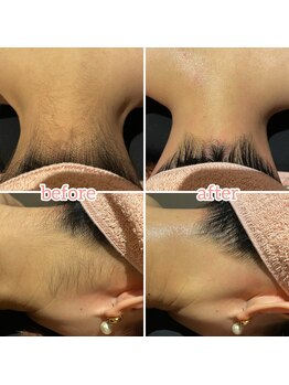 ジグリー(JIGGLY)/ワックス脱毛と光脱毛の併用◎