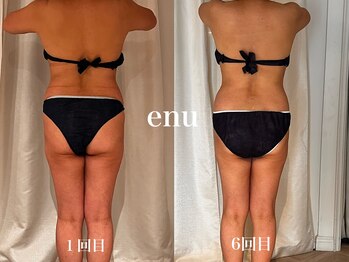 エヌ 白金台(enu)/大好評トリートメント