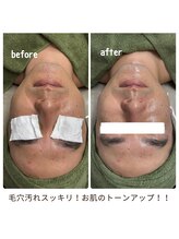 クラリ(Clari)/ハイドラ/毛穴洗浄/大濠エステ