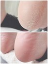 かかと角質ケア