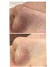 【人気Nｏ.2】乳酸ピーリングでつるん肌◇小鼻の毛穴改善！黒ずみ角栓吸引付