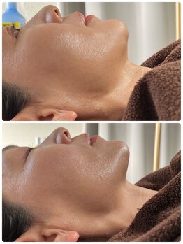 ミロク(369)/脂肪分解アンプルジェット注入