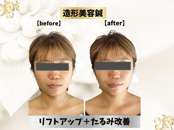 エモシオン トウキョウ(EMOTION TOKYO)/造形美容鍼