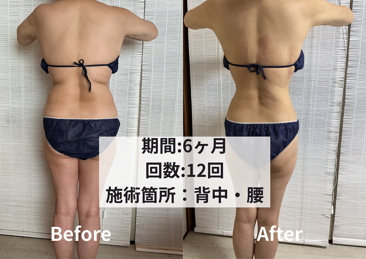 【新品】2本同時稼働/クリオリポリシス/360度脂肪冷却 脂肪冷却シート100枚 デュアルクライオ360＜Dual cryo 360＞