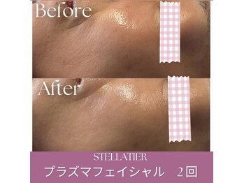 ステラティエ(Stellatier)/シミ/シワ/たるみ/リフトアップ