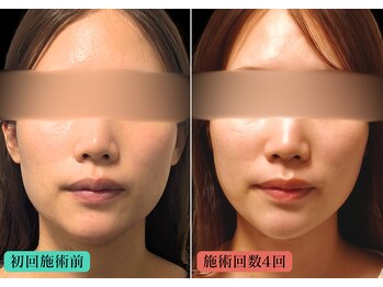やなけん 亀戸店の写真/「昔より顔が大きくなった」と感じたら、原因の食いしばりやたるみを改善◎シュッとした小顔に戻します