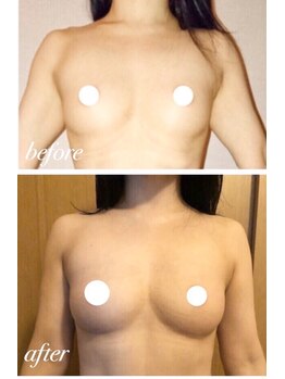 アンドモア(&more)/バストアップ症例