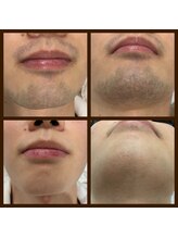 リアンジュ/ヒゲ脱毛の経過