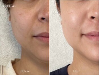 エステティックサロン エスぺランス(ESPERANCE)/1ヶ月でこの変化！