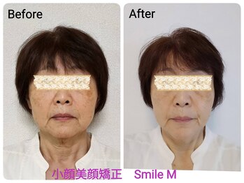 スマイルエム(SmileM)/