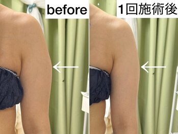 サロンリー(Salon Riee)/セル脂肪を撃退!