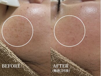 エース(ACE.)/シミ・くすみ改善☆