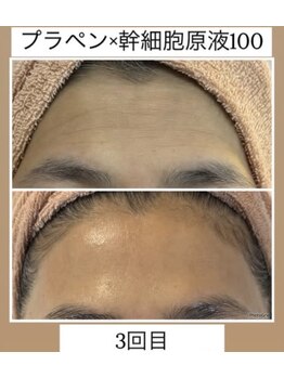 ルビー(RUBY)/しわ撲滅