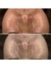 ≪メンズの肌を磨き上げる≫陶肌ピール