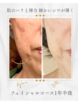 キラン 神戸店(Kiran)/遅くない60代のお肌も変わる！