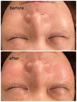 アニッシュ(ANISH)/毛穴洗浄×WiQo水光ピール